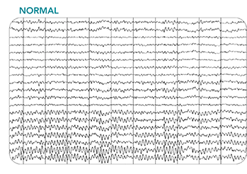 Thumbnail of a normal EEG
