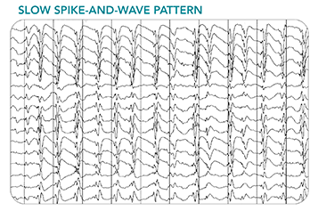 Thumbnail of an abnormal EEG with slow spikes and waves